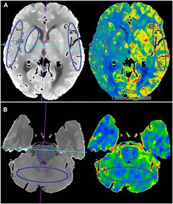 Cerebral Hemodynamic Changes After Endovascular Recanalization of Symptomatic Chronic Intracranial Artery Occlusion